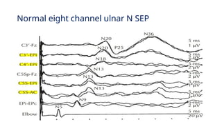 Comprehensive Overview of Somatosensory Evoked Potentials (SEPs) in ...