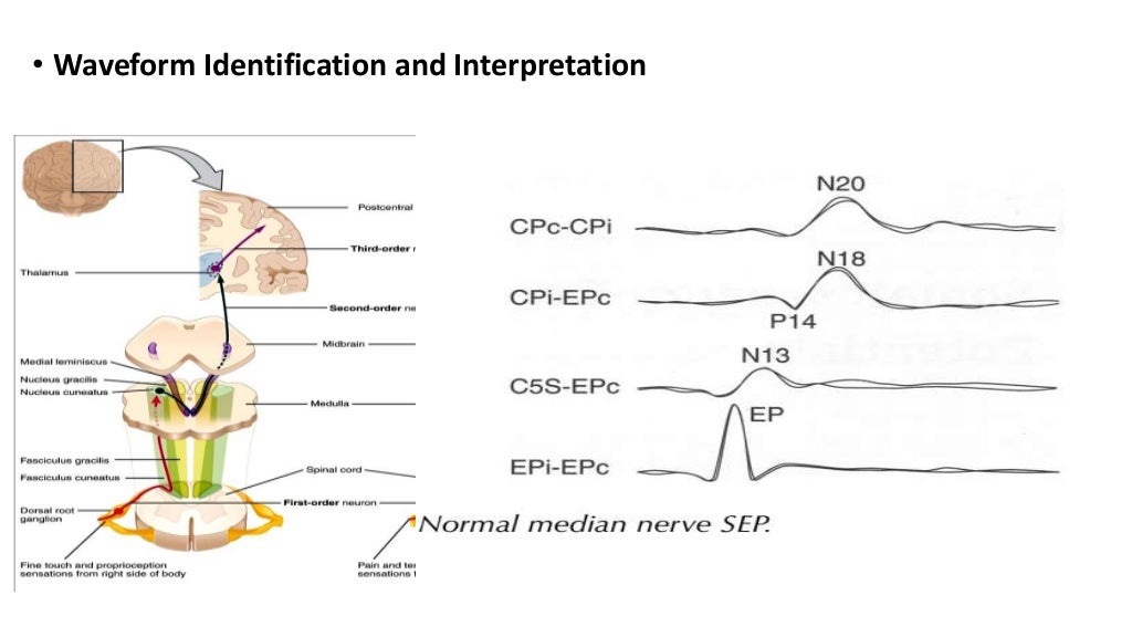 Somatosensory evoked potential