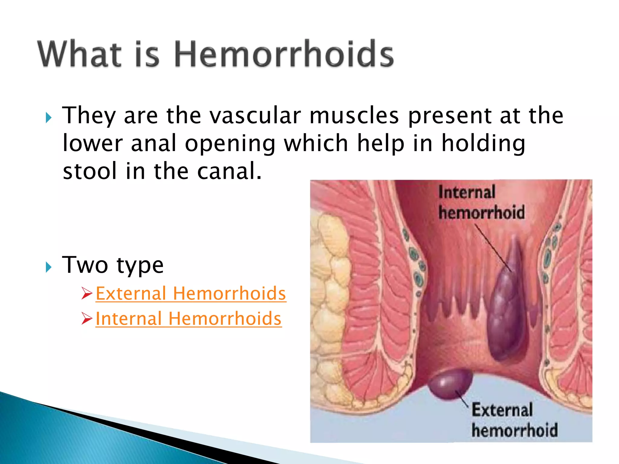 Some facts about internal hemorrhoids | PPTX