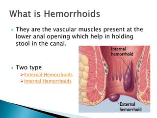  They are the vascular muscles present at the
lower anal opening which help in holding
stool in the canal.
 Two type
External Hemorrhoids
Internal Hemorrhoids
 