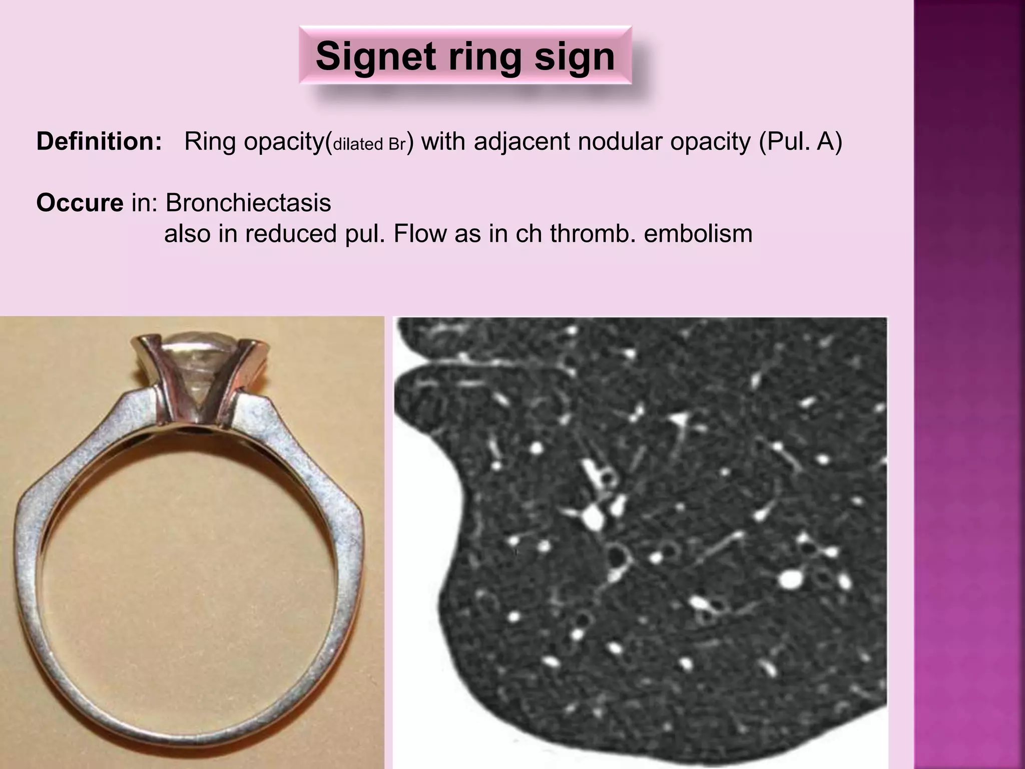 Signet ring sign
Definition: Ring opacity(dilated Br) with adjacent nodular opacity (Pul. A)
Occure in: Bronchiectasis
also in reduced pul. Flow as in ch thromb. embolism
 
