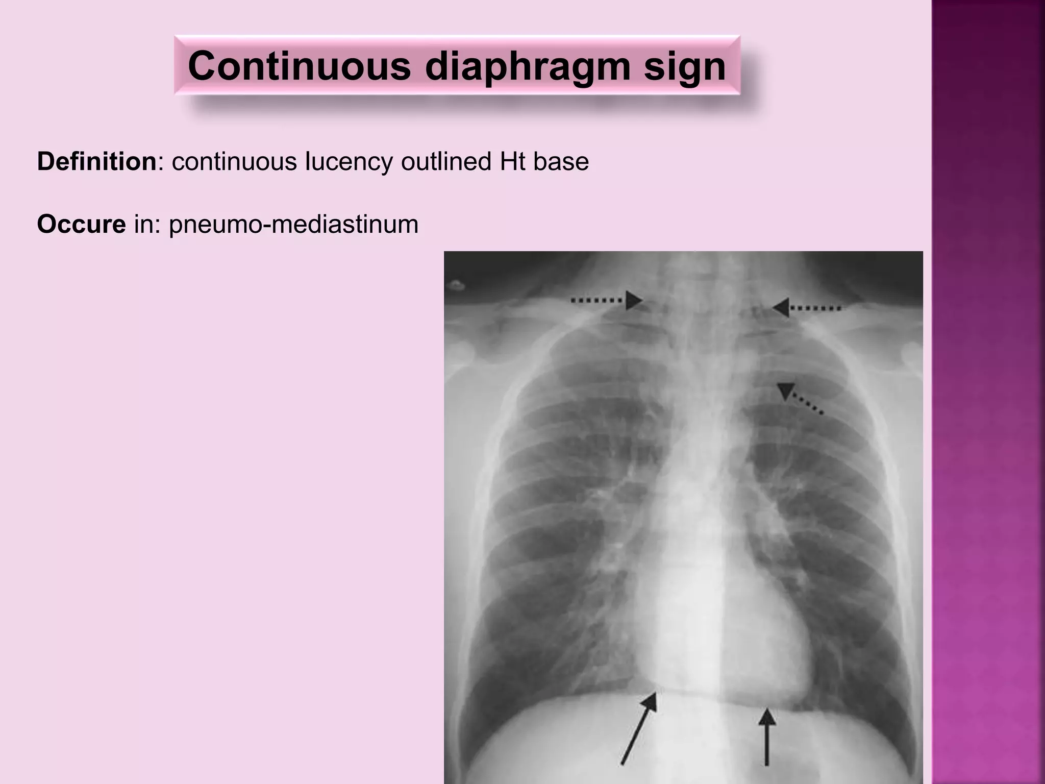 Continuous diaphragm sign
Definition: continuous lucency outlined Ht base
Occure in: pneumo-mediastinum
 