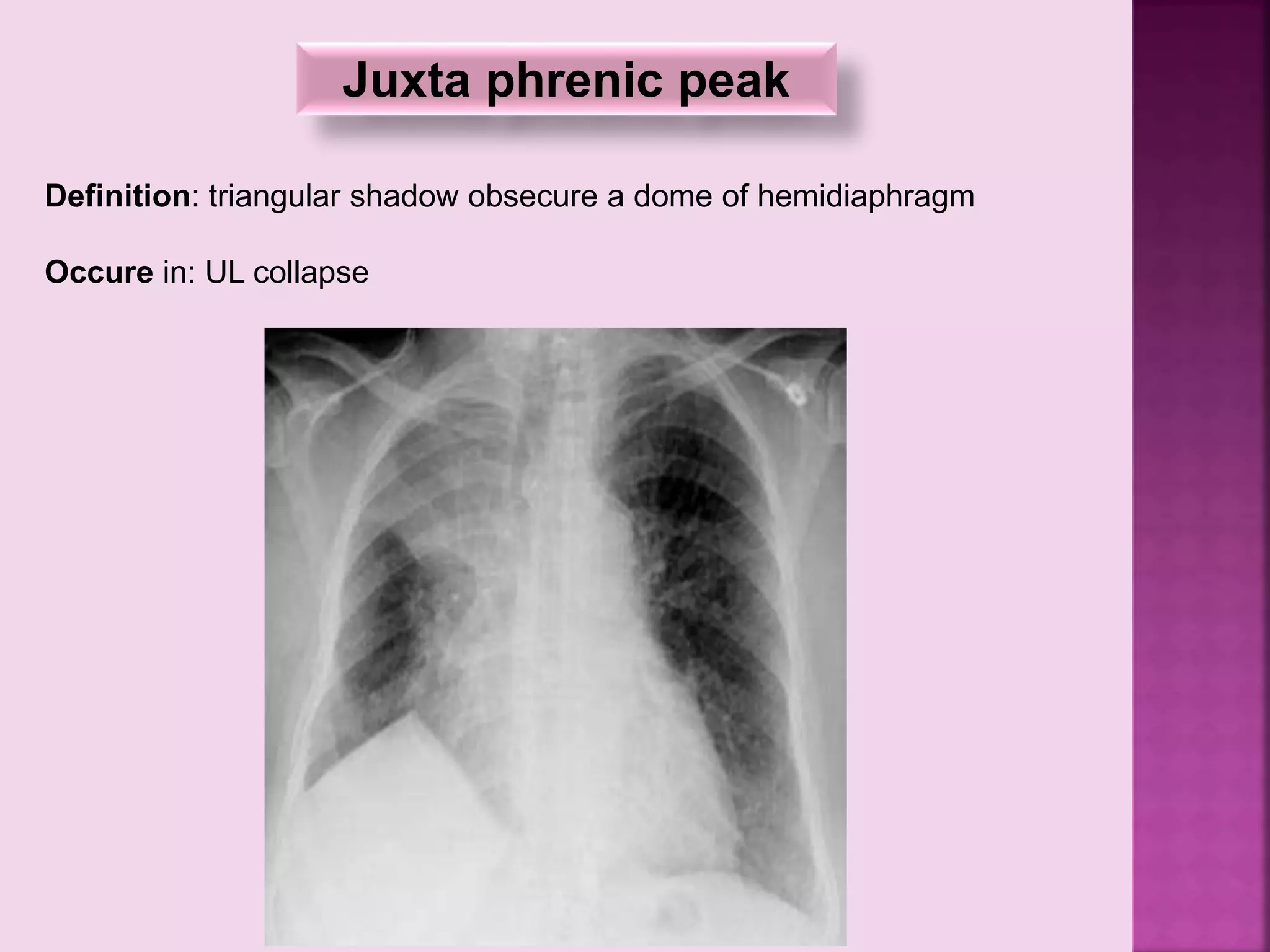 Juxta phrenic peak
Definition: triangular shadow obsecure a dome of hemidiaphragm
Occure in: UL collapse
 