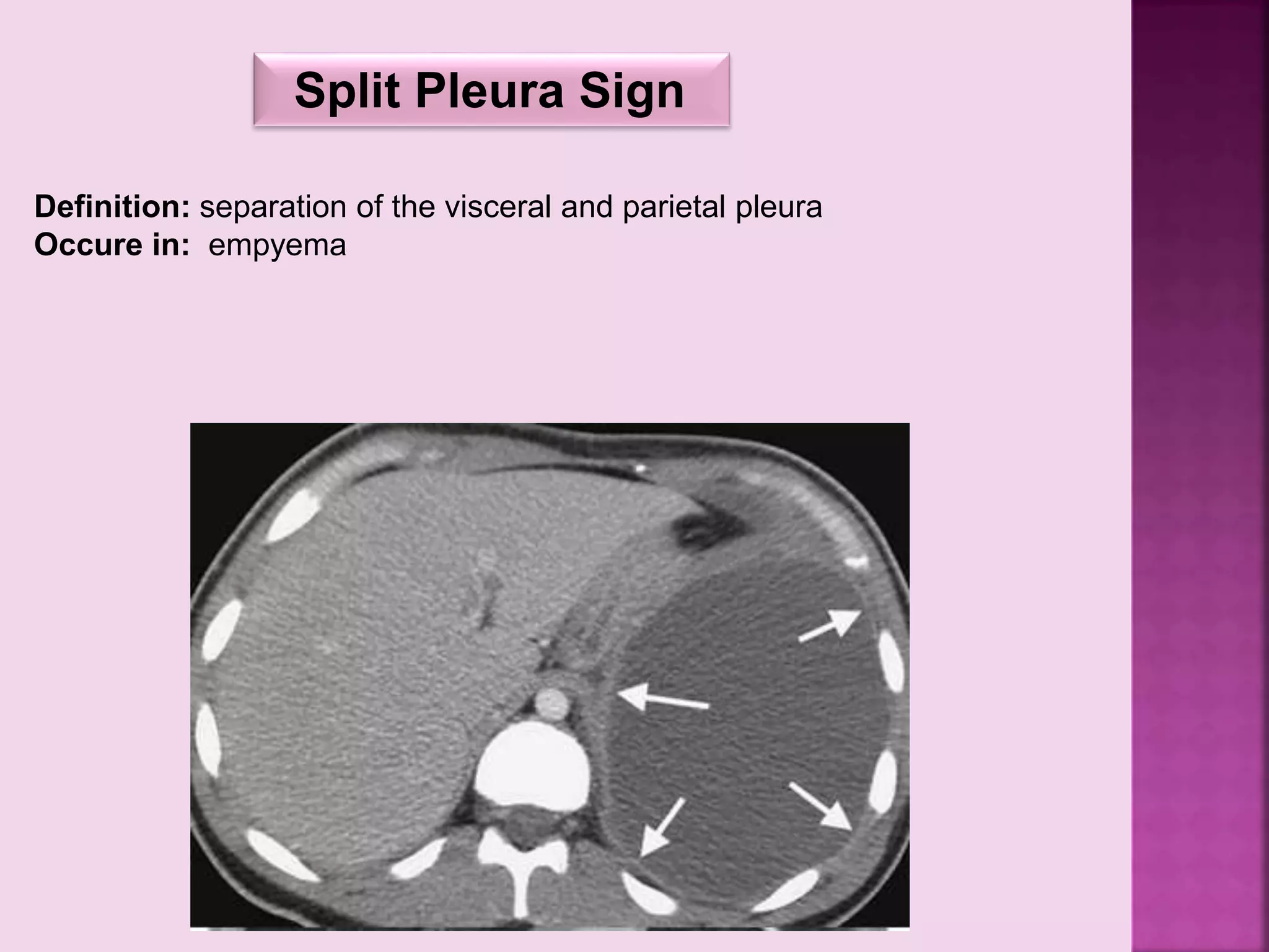 Definition: separation of the visceral and parietal pleura
Occure in: empyema
Split Pleura Sign
 