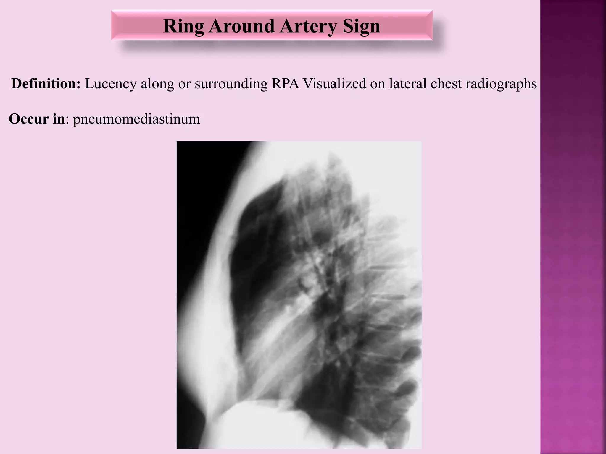 Ring Around Artery Sign
Definition: Lucency along or surrounding RPA Visualized on lateral chest radiographs
Occur in: pneumomediastinum
 