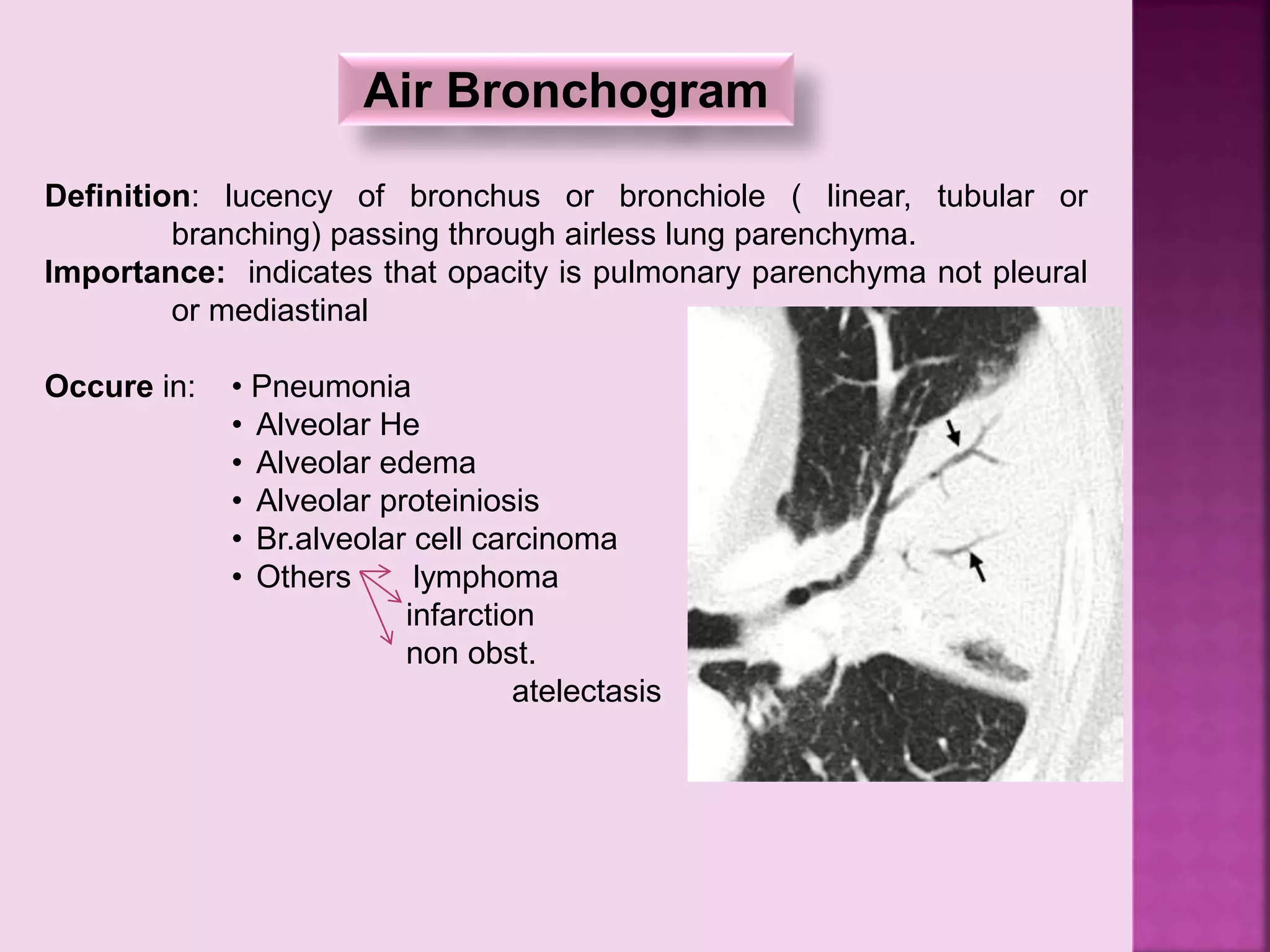 Definition: lucency of bronchus or bronchiole ( linear, tubular or
branching) passing through airless lung parenchyma.
Importance: indicates that opacity is pulmonary parenchyma not pleural
or mediastinal
Occure in: • Pneumonia
• Alveolar He
• Alveolar edema
• Alveolar proteiniosis
• Br.alveolar cell carcinoma
• Others lymphoma
infarction
non obst.
atelectasis
Air Bronchogram
 