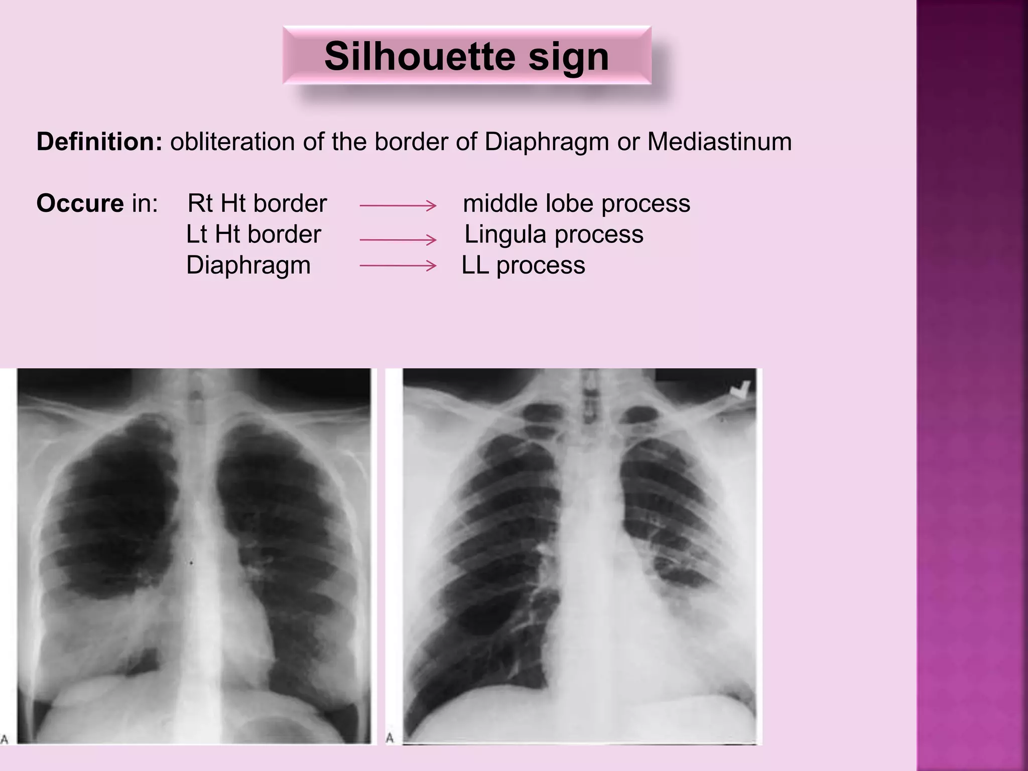Silhouette sign
Definition: obliteration of the border of Diaphragm or Mediastinum
Occure in: Rt Ht border middle lobe process
Lt Ht border Lingula process
Diaphragm LL process
 