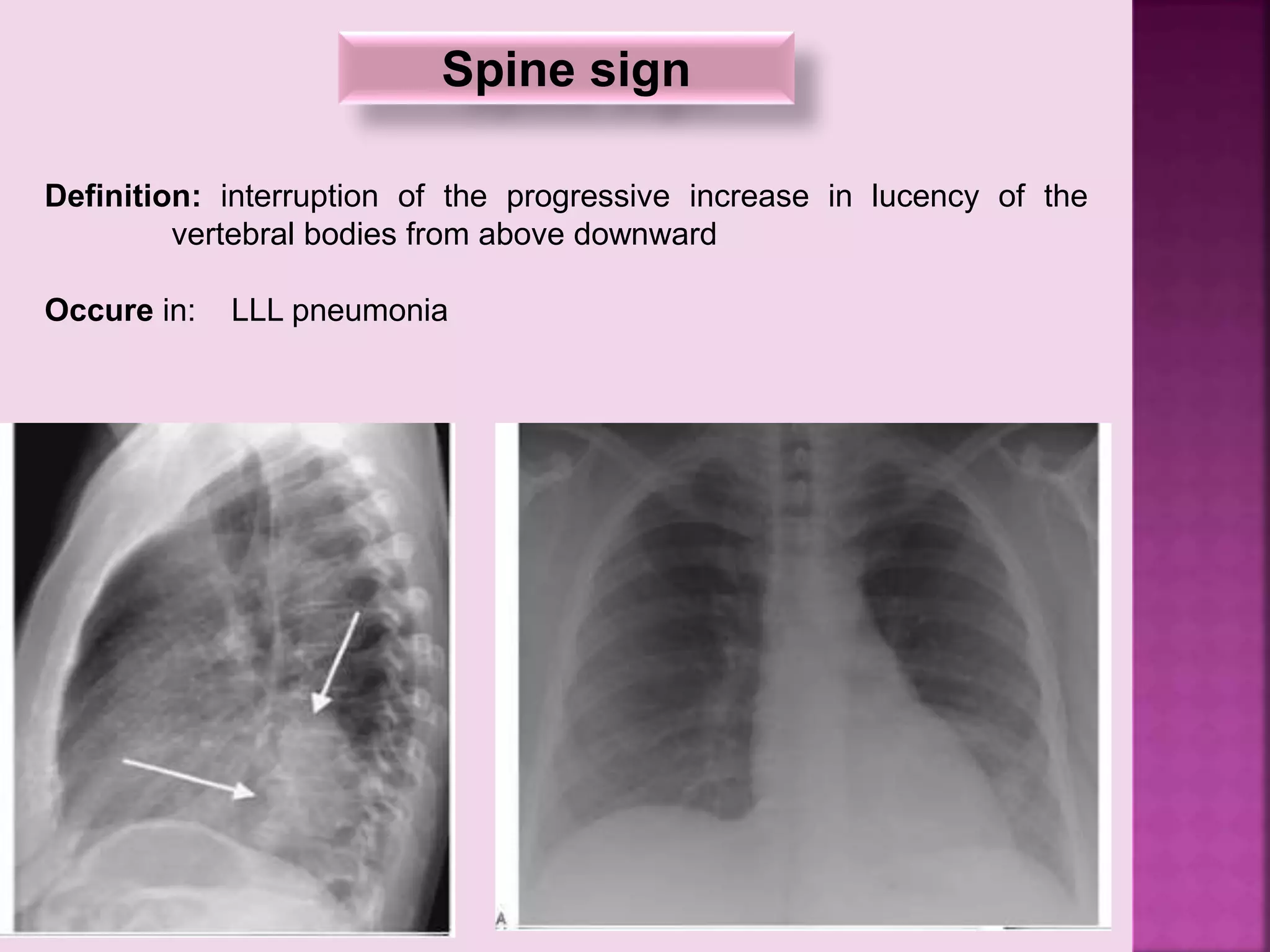 Spine sign
Definition: interruption of the progressive increase in lucency of the
vertebral bodies from above downward
Occure in: LLL pneumonia
 