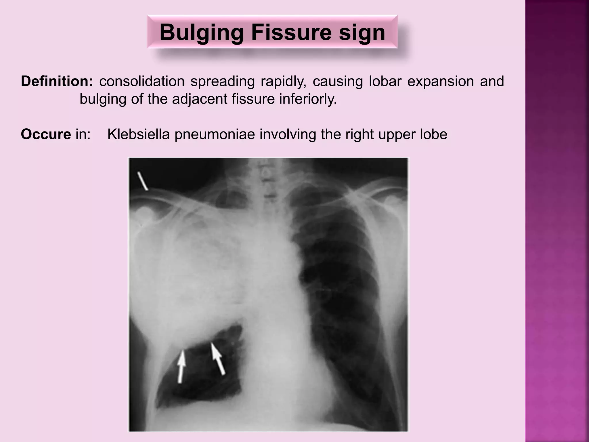 Bulging Fissure sign
Definition: consolidation spreading rapidly, causing lobar expansion and
bulging of the adjacent fissure inferiorly.
Occure in: Klebsiella pneumoniae involving the right upper lobe
 