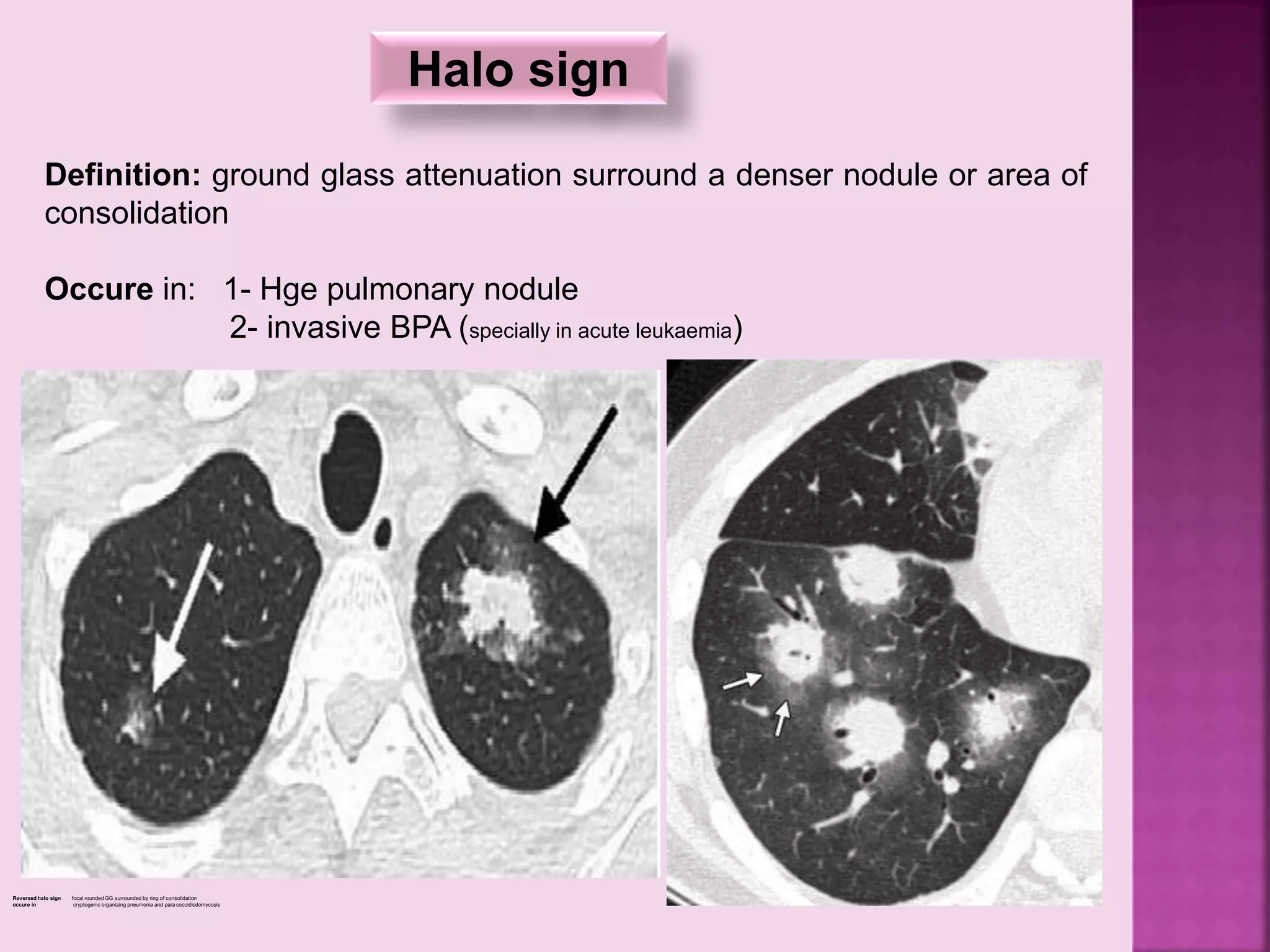 Halo sign
Definition: ground glass attenuation surround a denser nodule or area of
consolidation
Occure in: 1- Hge pulmonary nodule
2- invasive BPA (specially in acute leukaemia)
Reversed halo sign focal rounded GG surrounded by ring of consolidation
occure in cryptogenic organizing pneumonia and para coccidiodomycosis
 