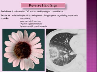 Reverse Halo Sign
Definition: focal rounded GG surrounded by ring of consolidation.
Also in: sarcoidosis,
para coccidiodomycosis
Wgener’s granulomatosis
lymphomatoid granulomatosis
Occur in: relatively specific to a diagnosis of cryptogenic organizing pneumonia
 