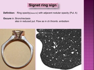 Signet ring sign
Definition: Ring opacity(dilated Br) with adjacent nodular opacity (Pul. A)
Occure in: Bronchiectasis
also in reduced pul. Flow as in ch thromb. embolism
 