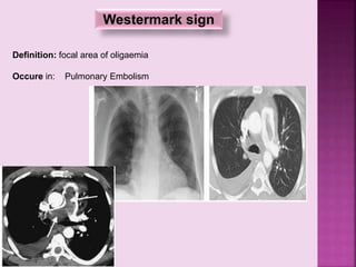 Westermark sign
Definition: focal area of oligaemia
Occure in: Pulmonary Embolism
 