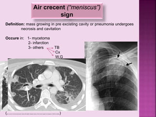 Air crecent (“meniscus”)
sign
Definition: mass growing in pre excisting cavity or pneumonia undergoes
necrosis and cavitation
Occure in: 1- mycetoma
2- infarction
3- others TB
Cx
W.G
(when occure in immunocompromized invasive BPA patient indicates recovery of the immune sysytem and response of WBCs to infection)
 
