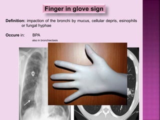 Finger in glove sign
Definition: impaction of the bronchi by mucus, cellular depris, esinophils
or fungal hyphae
Occure in: BPA
also in bronchiectasis
 