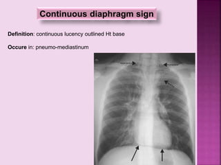 Continuous diaphragm sign
Definition: continuous lucency outlined Ht base
Occure in: pneumo-mediastinum
 