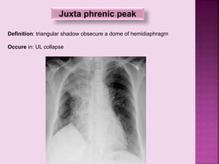 Juxta phrenic peak
Definition: triangular shadow obsecure a dome of hemidiaphragm
Occure in: UL collapse
 