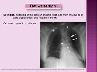 Flat waist sign
Definition: flattening of the contour of aortic knob and main P.A due to Lt
ward displacement and rotation of the Ht
Occure in: sever LLL collapse
loss of the medial contour of the left hemidiaphragm, which is known as the silhouette sign. The left lower lobe bronchus has a more vertical course than normal (arrowheads). Leftward displacement and rotation of the heart in left lower lobe collapse results in flattening of the contours of the aortic knob and adjacent main pulmonary artery (arrows),
 