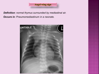 Occure in: Pneumomediastinum in a neonate.
Definition: normal thymus surrounded by mediastinal air.
Angel wing sign
 