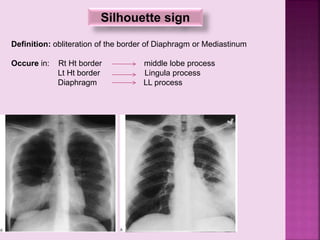 Silhouette sign
Definition: obliteration of the border of Diaphragm or Mediastinum
Occure in: Rt Ht border middle lobe process
Lt Ht border Lingula process
Diaphragm LL process
 