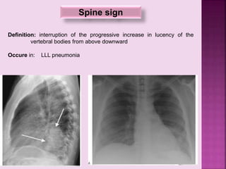 Spine sign
Definition: interruption of the progressive increase in lucency of the
vertebral bodies from above downward
Occure in: LLL pneumonia
 