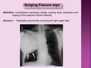 Bulging Fissure sign
Definition: consolidation spreading rapidly, causing lobar expansion and
bulging of the adjacent fissure inferiorly.
Occure in: Klebsiella pneumoniae involving the right upper lobe
 