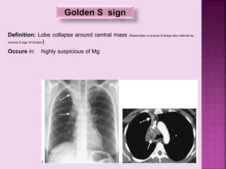 Golden S sign
Definition: Lobe collapse around central mass (Resembles a reverse S shape also referred as
reverse S sign of Golden)
Occure in: highly suspicious of Mg
 
