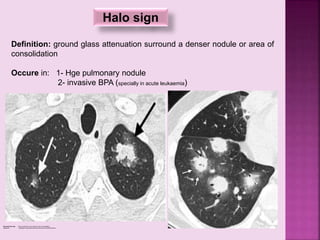 Halo sign
Definition: ground glass attenuation surround a denser nodule or area of
consolidation
Occure in: 1- Hge pulmonary nodule
2- invasive BPA (specially in acute leukaemia)
Reversed halo sign focal rounded GG surrounded by ring of consolidation
occure in cryptogenic organizing pneumonia and para coccidiodomycosis
 