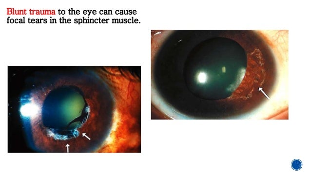 misshapen cornea misshapen cornea