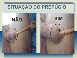SITUAÇÃO DO PREPÚCIO
NÃO SIM
 
