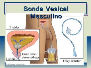 Sonda VesicalSonda Vesical
MasculinoMasculino
 