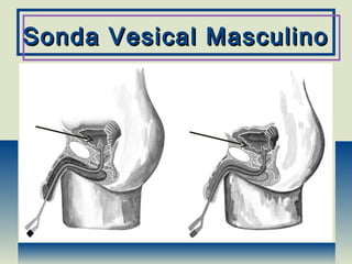 Sonda Vesical MasculinoSonda Vesical Masculino
 