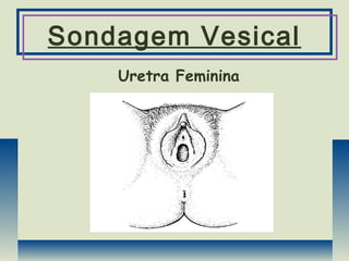 Sondagem Vesical
Uretra Feminina
 