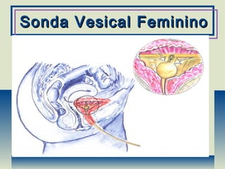 Sonda Vesical FemininoSonda Vesical Feminino
 