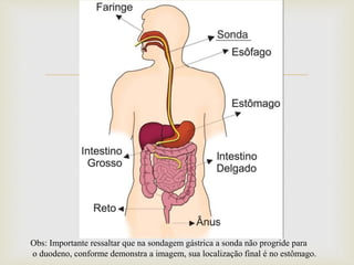 
Obs: Importante ressaltar que na sondagem gástrica a sonda não progride para
o duodeno, conforme demonstra a imagem, sua localização final é no estômago.
 