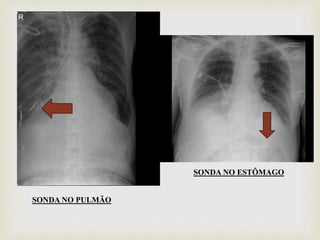 
SONDA NO PULMÃO
SONDA NO ESTÔMAGO
 