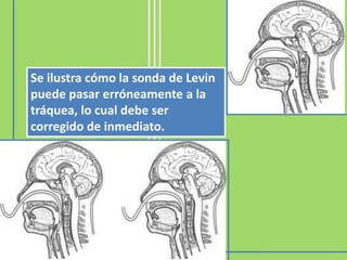 Se ilustra cómo la sonda de Levin
puede pasar erróneamente a la
tráquea, lo cual debe ser
corregido de inmediato.
 