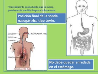 Introducir la sonda hasta que la marca
previamente medida llegue a la fosa nasal.

        Posición final de la sonda
        nasogástrica tipo Levin.




                                    No debe quedar enredada
                                    en el estómago.
 