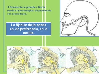 Finalmente se procede a fijar la
sonda a la zona elegida, de preferencia
con esparadrapo.



   La fijación de la sonda
  es, de preferencia, en la
            mejilla.
 