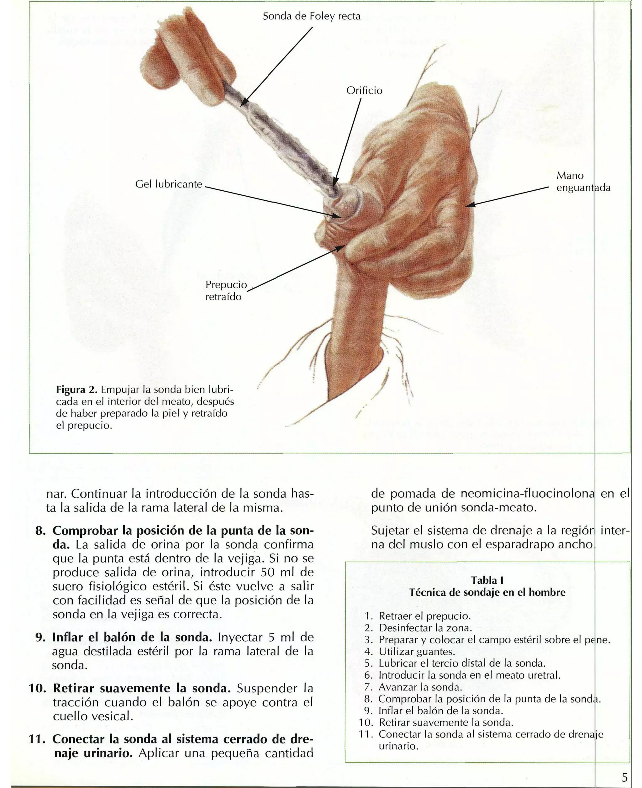 Sondaje Vesical PDF sondaje-vesical-pdf