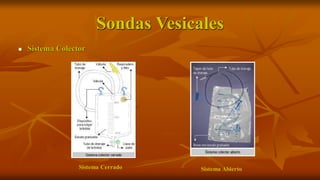 Sondas Vesicales
 Sistema Colector
Sistema Cerrado Sistema Abierto
 