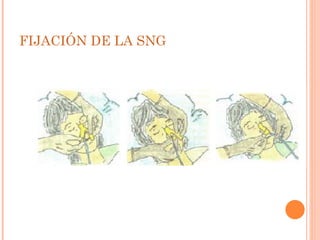 FIJACIÓN DE LA SNG 