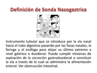 Instrumento tubular que se introduce por la vía nasal
hacia el tubo digestivo pasando por las fosas nasales, la
faringe y el esófago para alojar su último extremo a
nivel gástrico o duodenal. Puede cumplir misiones de
aspiración de la secreción gastroduodenal o constituir
la vía a través de la cual se administra la alimentación
enteral. Ver obstrucción intestinal.
 