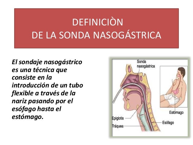 Sonda nasogastrica Sonda nasogastrica