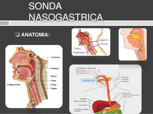 Sonda Nasogástrica