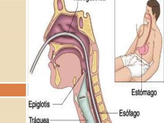 Sonda naso gástrica