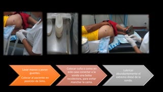 Lavar manos y poner
guantes.
Colocar al paciente en
posición de Sims.
Colocar cuña o como en
este caso conectar a la
sonda una bolsa
recolectora, para evitar
manchar la cama.
Lubricar
abundantemente el
extremo distal de la
sonda.
 