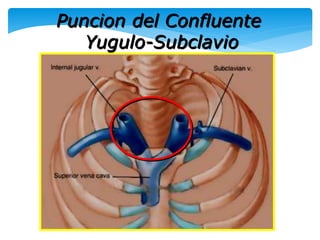 SONDAS; CANULAS Y CATETERES | PPTX
