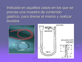 -

Indicada en aquellos casos en los que se
precise una muestra de contenido
gástrico, para drenar el mismo y realizar
lavados.

 