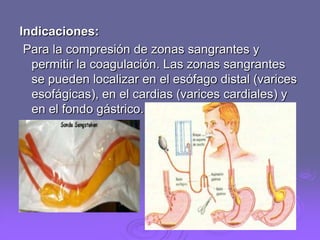 Indicaciones:
Para la compresión de zonas sangrantes y
permitir la coagulación. Las zonas sangrantes
se pueden localizar en el esófago distal (varices
esofágicas), en el cardias (varices cardiales) y
en el fondo gástrico.

 